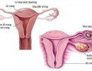  Nhận biết sớm dấu hiệu mang thai ngoài tử cung