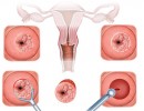 Bệnh viêm cổ tử cung: Nguyên nhân, dấu hiệu và cách chữa bệnh
