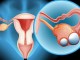 Cách phát hiện ung thư buồng trứng nữ giới nên cảnh giác
