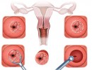 Viêm lộ tuyến cổ tử cung là gì? Dấu hiệu và cách chữa trị bệnh